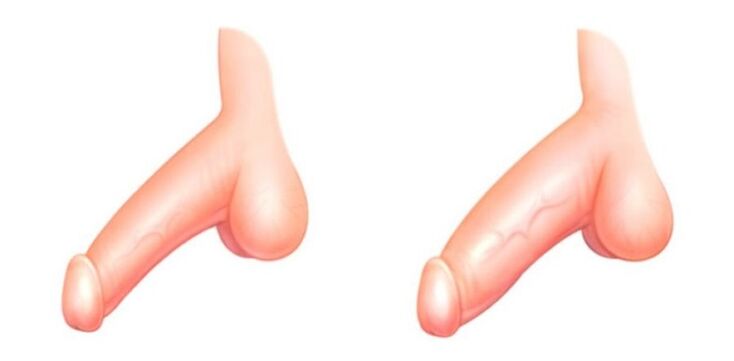 pénisz a bővítés előtt és után
